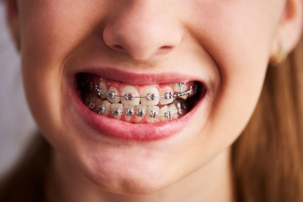 Wilton Manors Braces Specialist