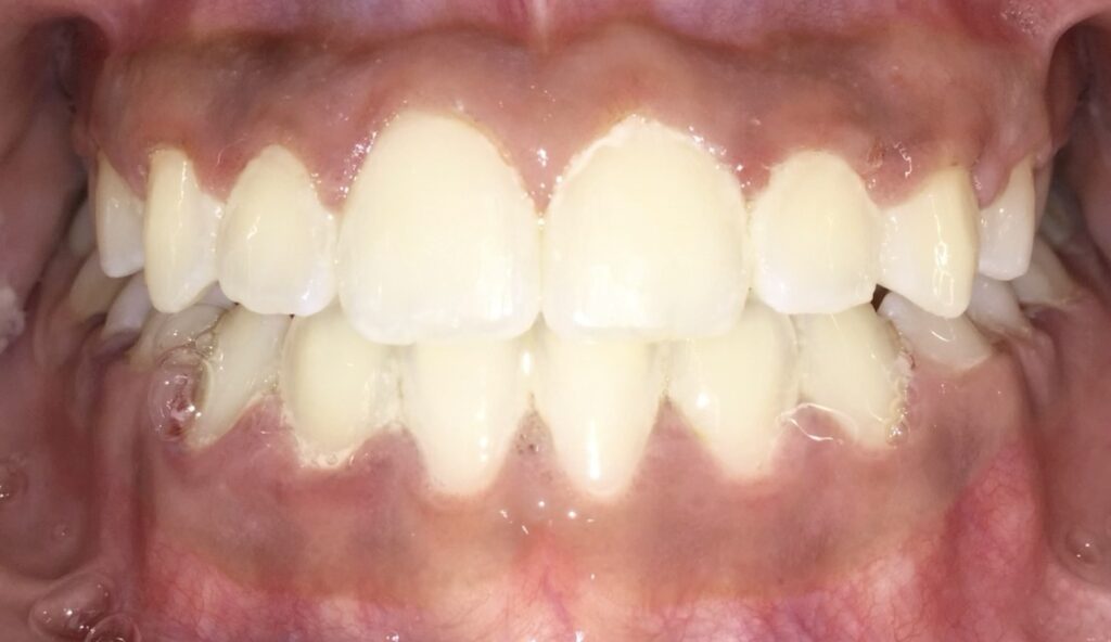 Patient 1 after orthodontic treatment, front view
