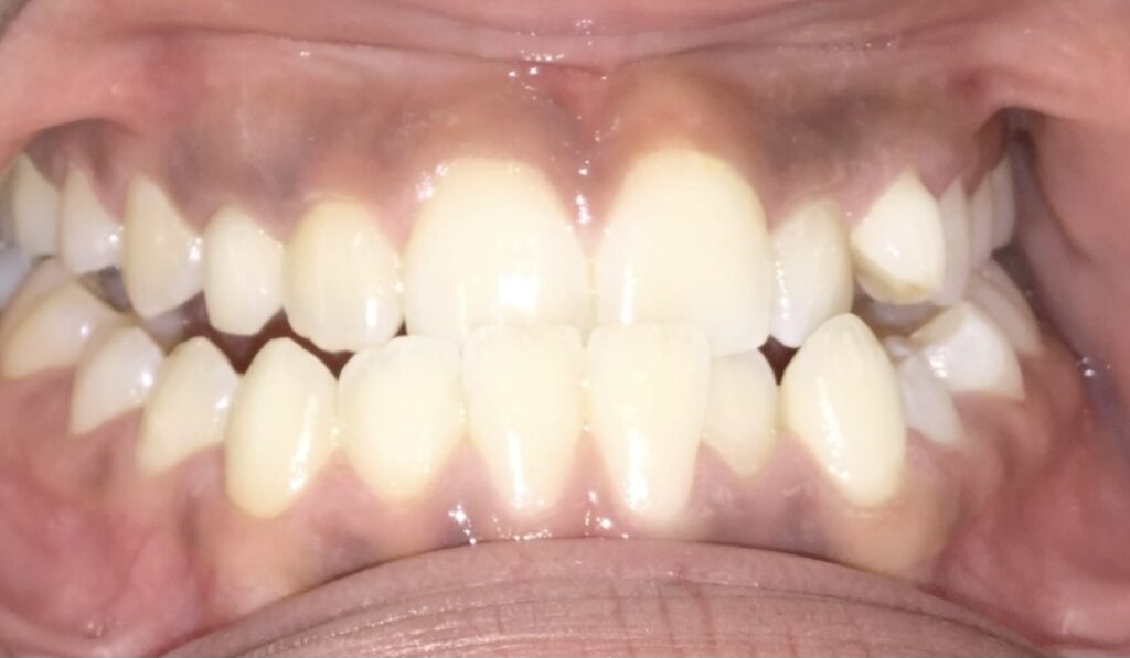 Patient 1 before orthodontic treatment, front view