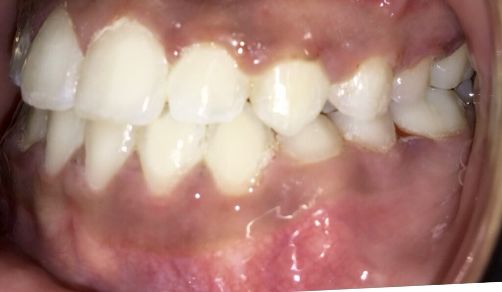 Patient 1 after orthodontic treatment, side view