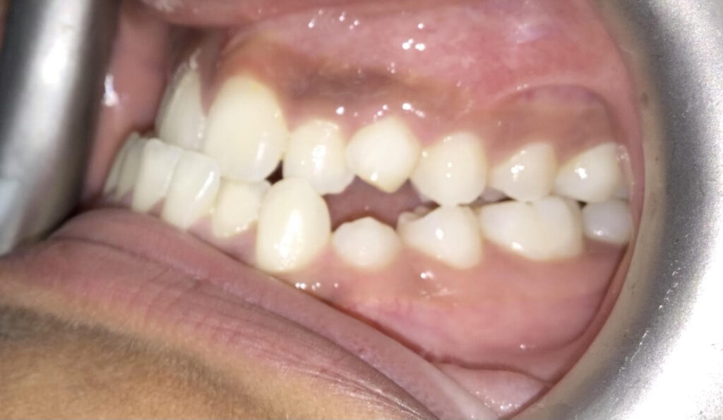 Patient 1 before orthodontic treatment, side view