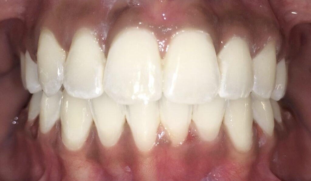 Patient 2 after orthodontic treatment, front view