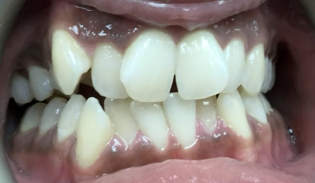 Patient 2 before orthodontic treatment, front view