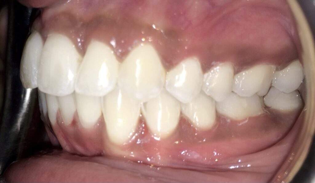 Patient 2 after orthodontic treatment, side view