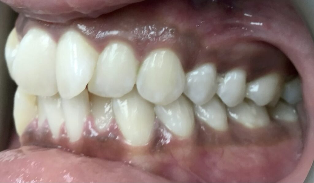 Patient 2 before orthodontic treatment, side view