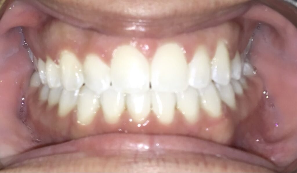 Patient 3 after orthodontic treatment, front view