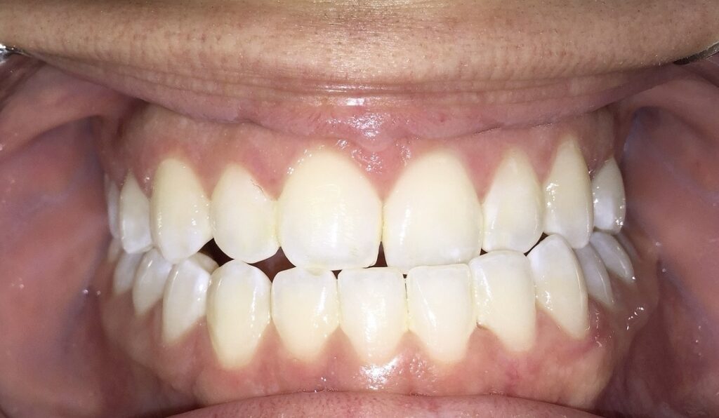 Patient 3 before orthodontic treatment, front view