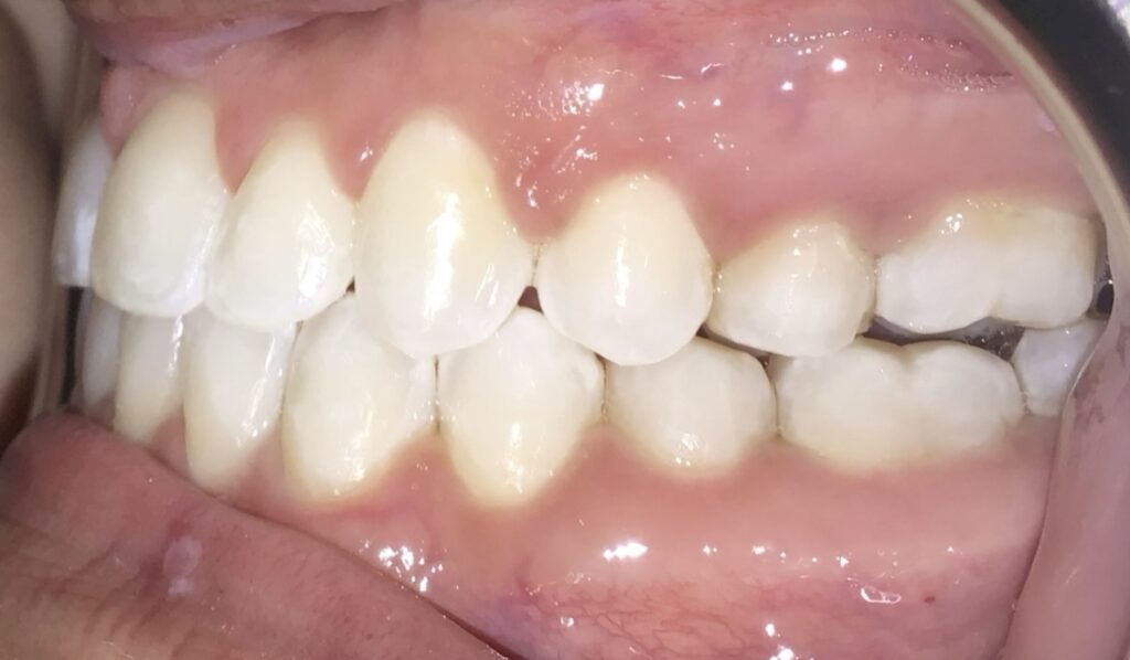 Patient 3 after orthodontic treatment, side view