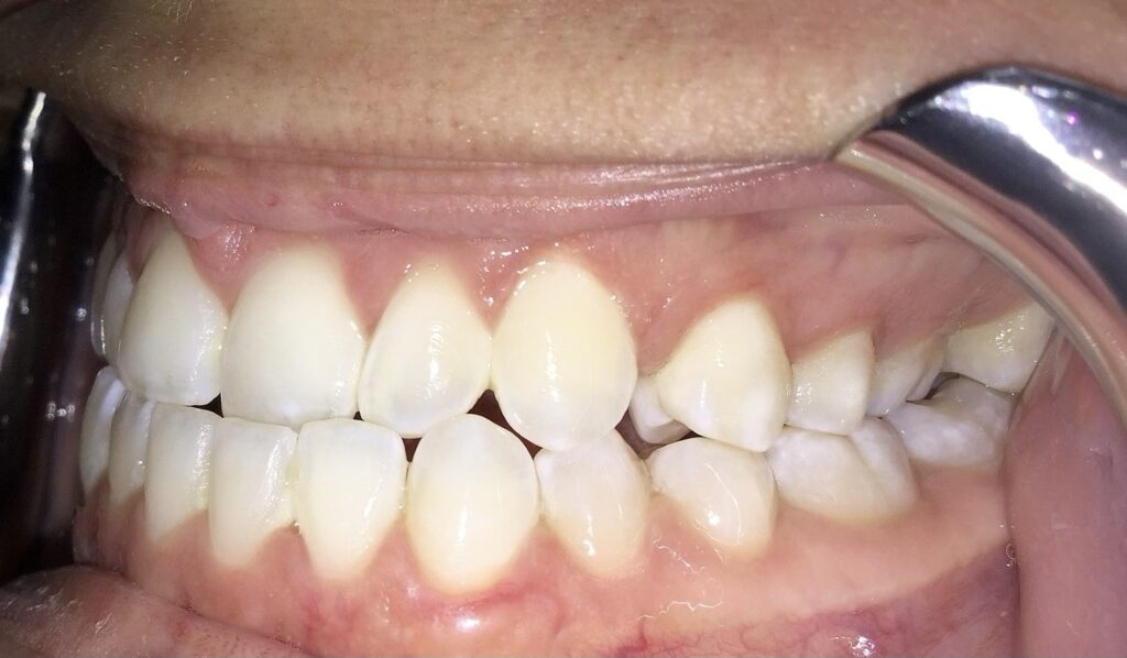 Patient 3 before orthodontic treatment, side view