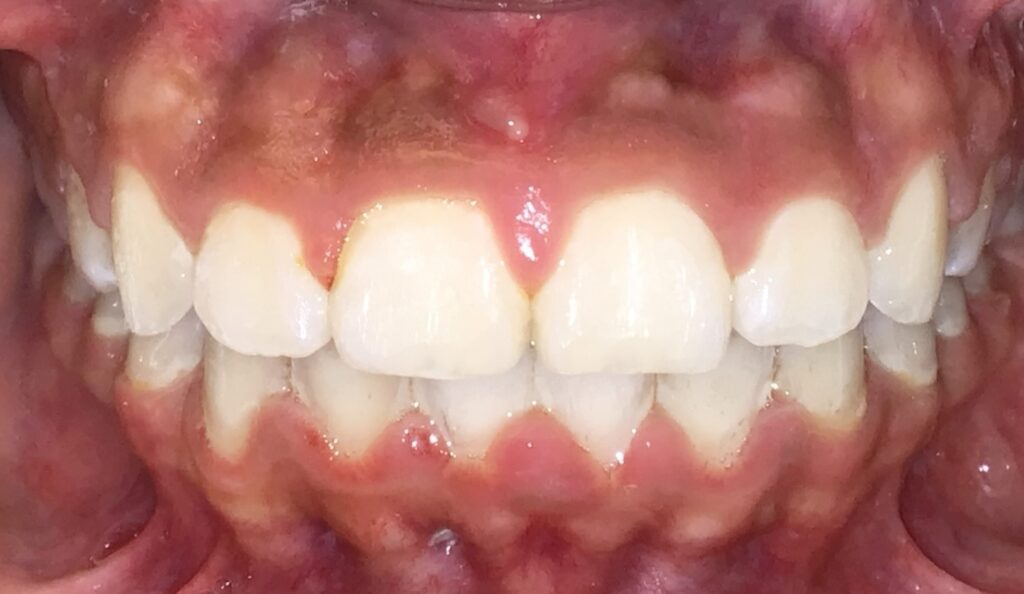 Patient 4 after orthodontic treatment, front view