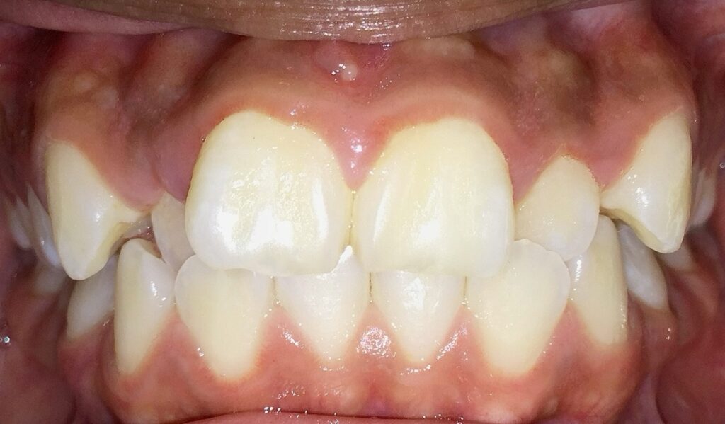 Patient 4 before orthodontic treatment, front view
