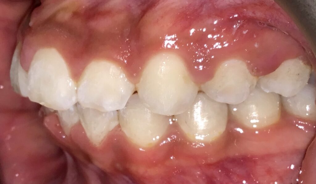 Patient 4 after orthodontic treatment, side view