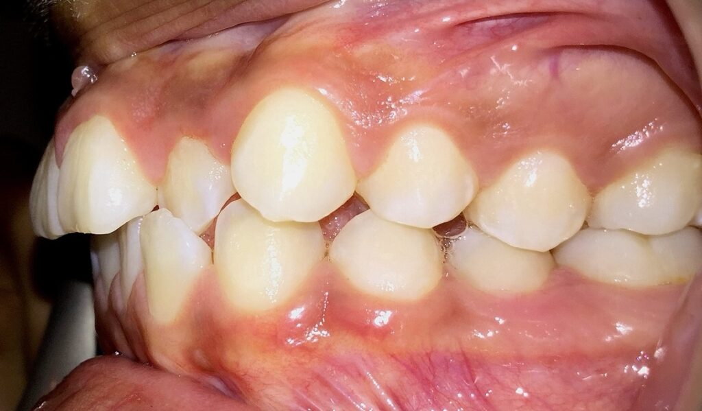 Patient 4 before orthodontic treatment, side view