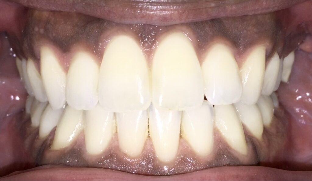 Patient 5 after orthodontic treatment, front view