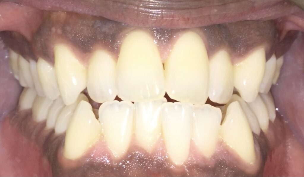 Patient 5 before orthodontic treatment, front view