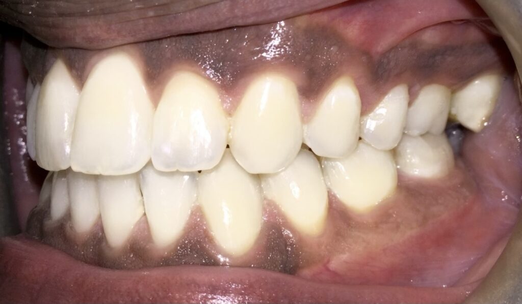 Patient 5 after orthodontic treatment, side view