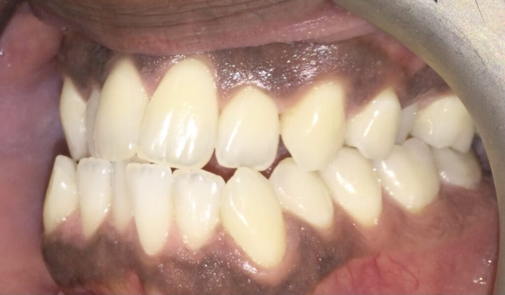 Patient 5 before orthodontic treatment, side view