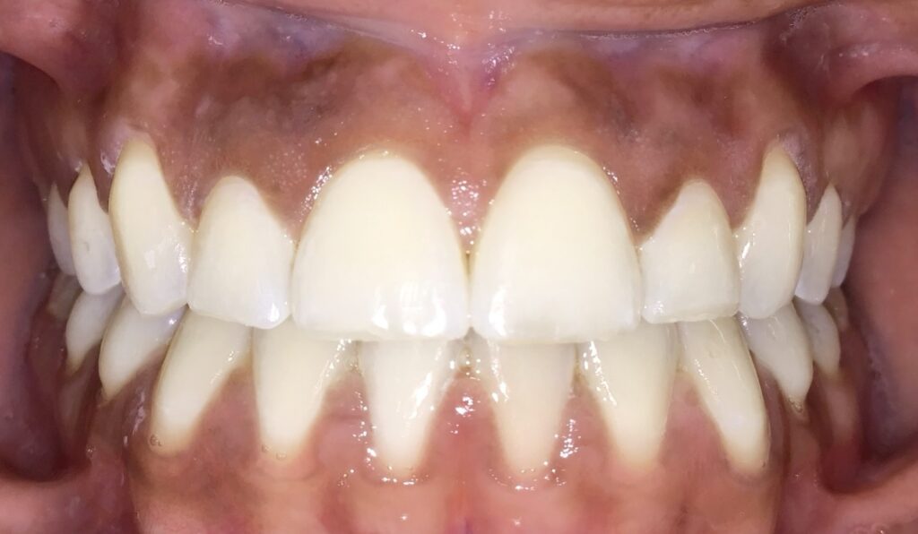 Patient 6 after orthodontic treatment, front view