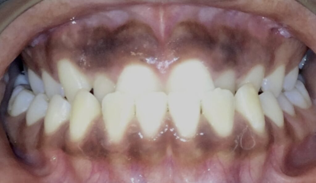 Patient 6 before orthodontic treatment, front view