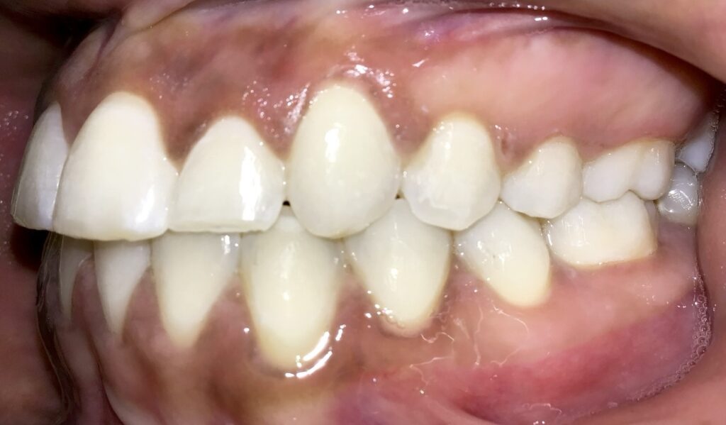 Patient 6 after orthodontic treatment, side view
