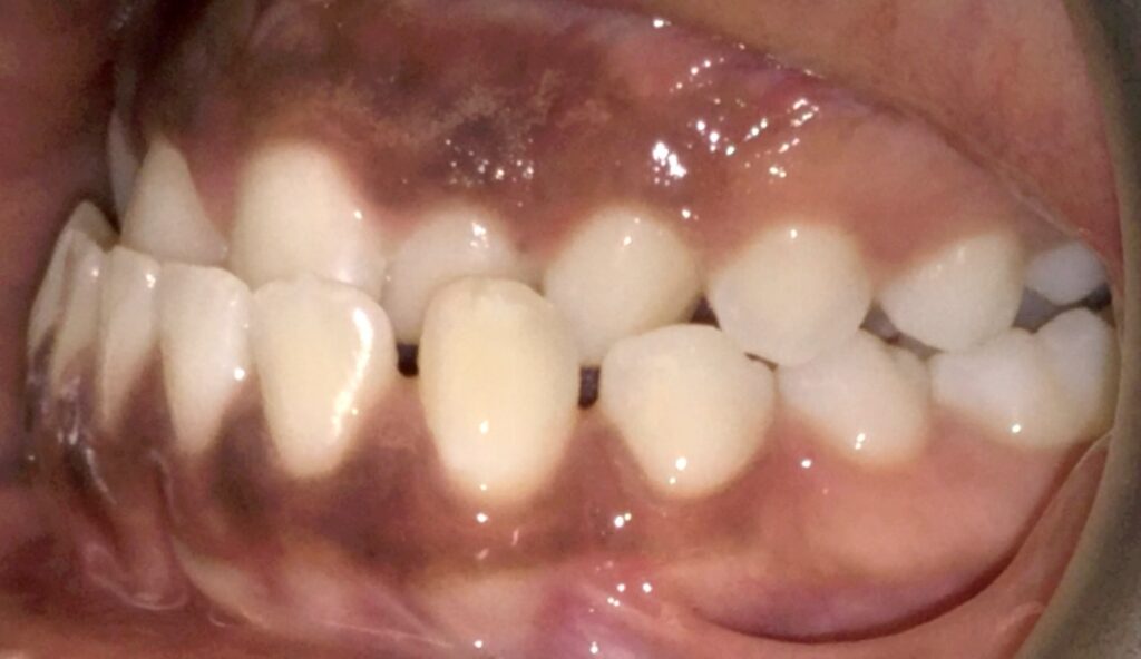 Patient 6 before orthodontic treatment, side view