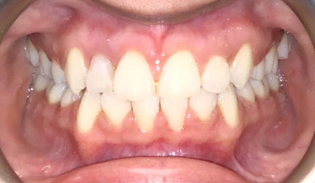 Patient 7 after orthodontic treatment, front view