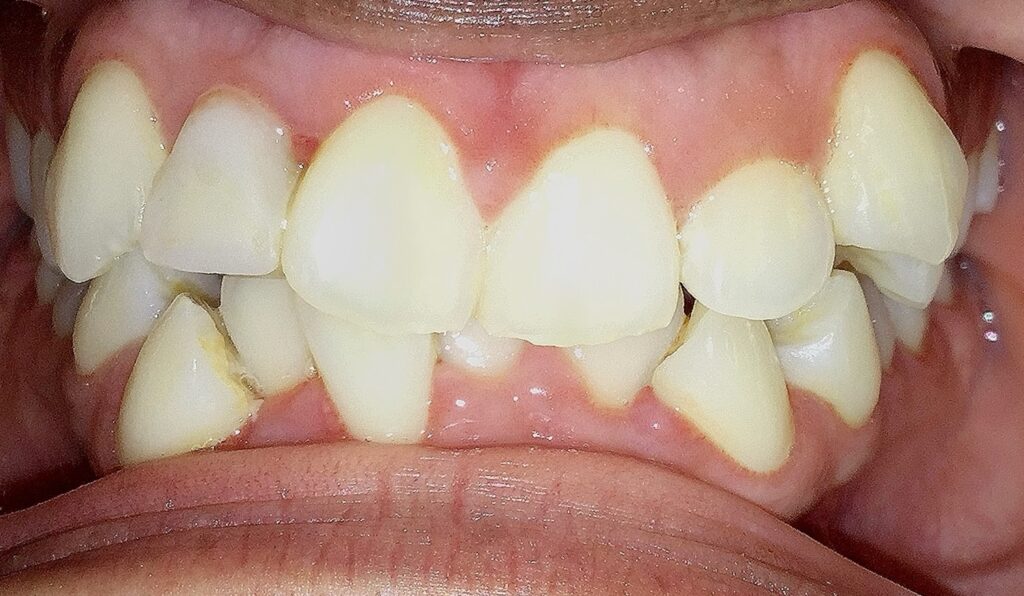 Patient 7 before orthodontic treatment, front view