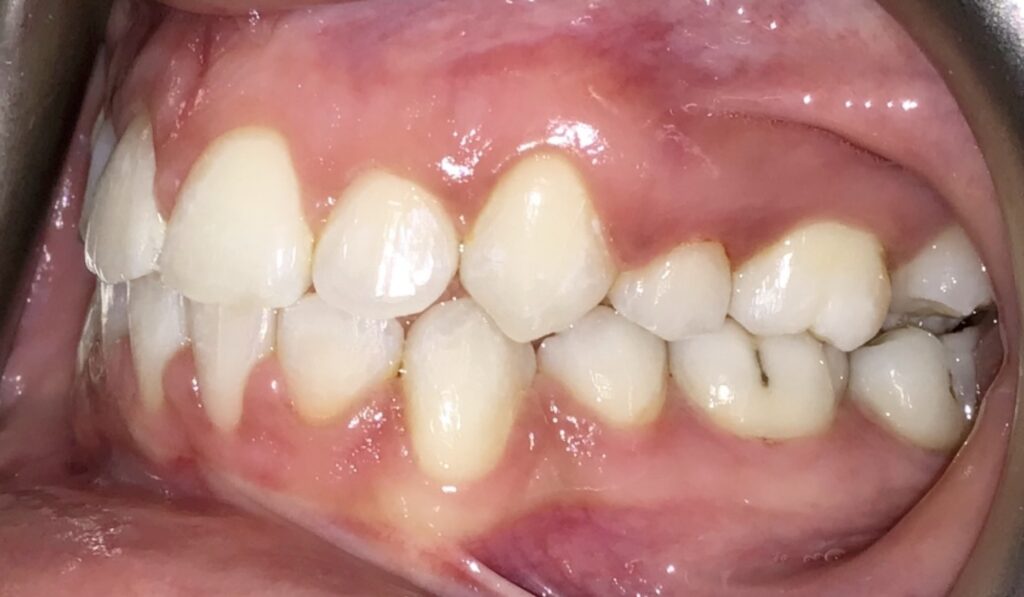 Patient 7 after orthodontic treatment, side view