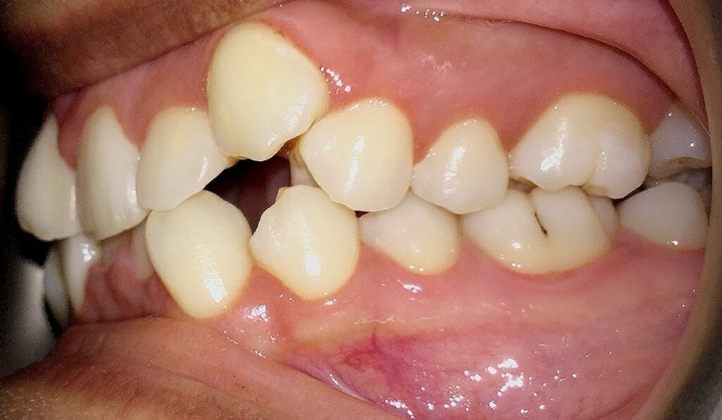 Patient 7 before orthodontic treatment, side view