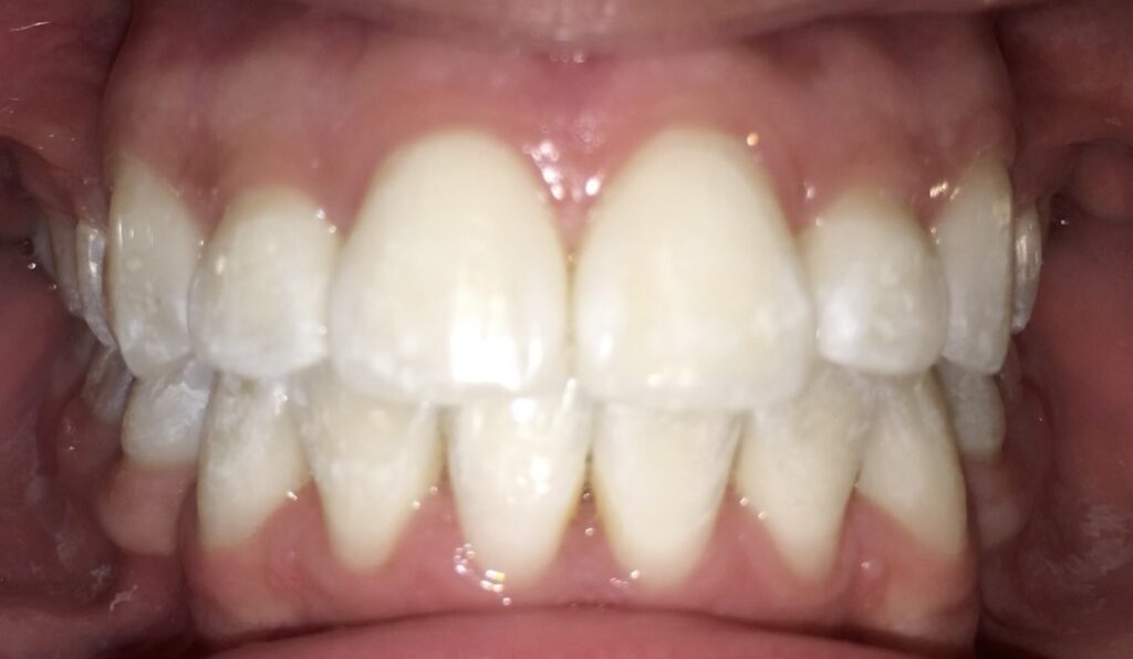 Patient 8 after orthodontic treatment, front view