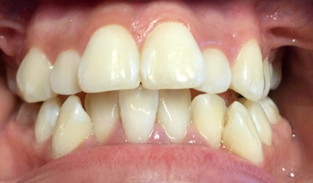 Patient 8 before orthodontic treatment, front view