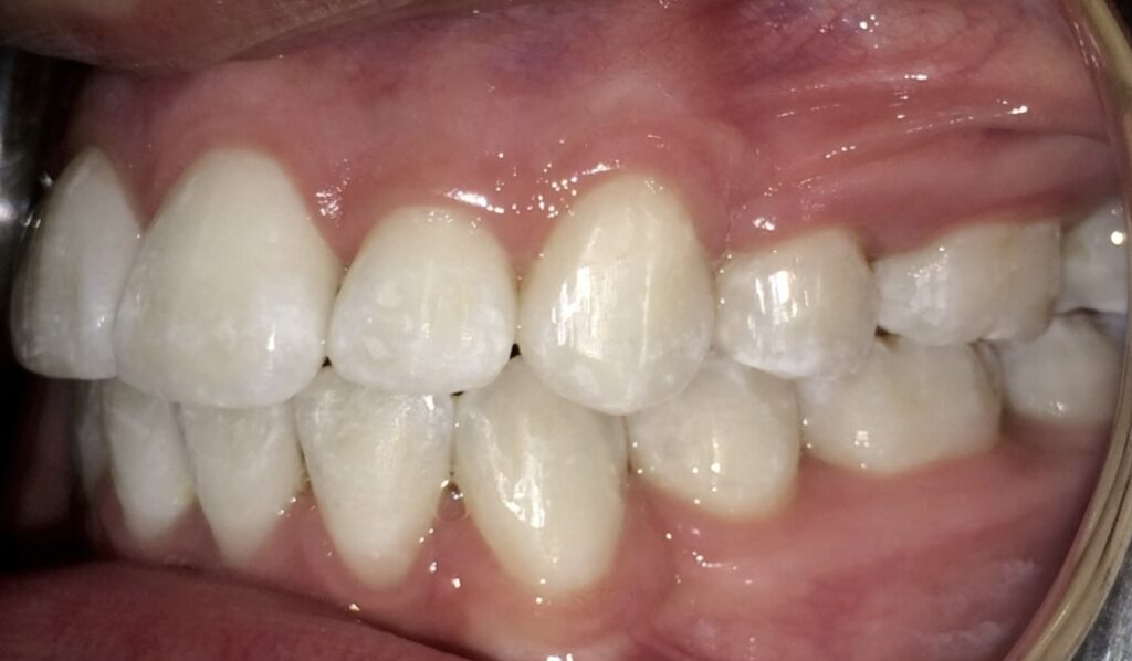 Patient 8 after orthodontic treatment, side view