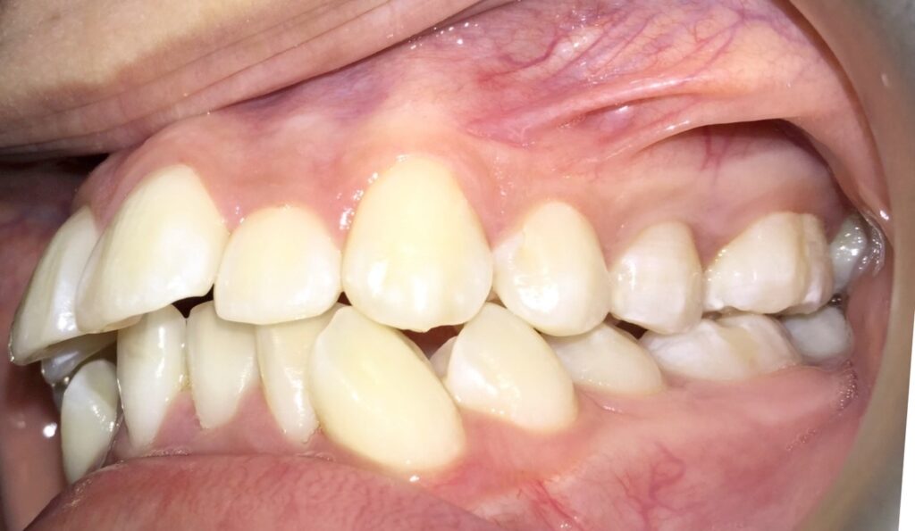 Patient 8 before orthodontic treatment, side view